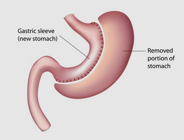 Exploring Alternatives to Lap Band Removal Surgery: A Guide to Bariatric Solutions